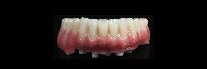 All on 4 Dental Implants: Case  14 - Zirconia Bridge