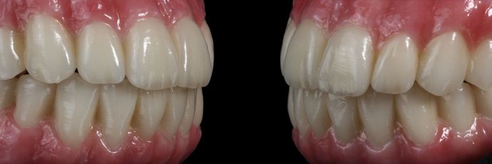 All on 4 Dental Implants: Case  14 - Zirconia Bridge