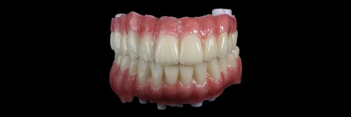 All on 4 Dental Implants: Case  14 - Zirconia Bridge