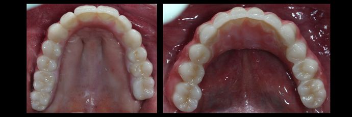 All on 4 Dental Implants: Case  14 - Try In