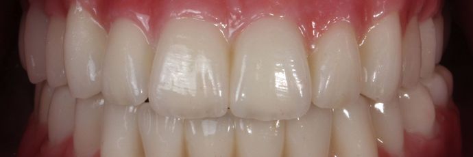 All on 4 Dental Implants: Case  14 - Try In