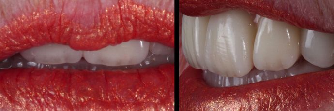 All on 4 Dental Implants: Case  14 - After