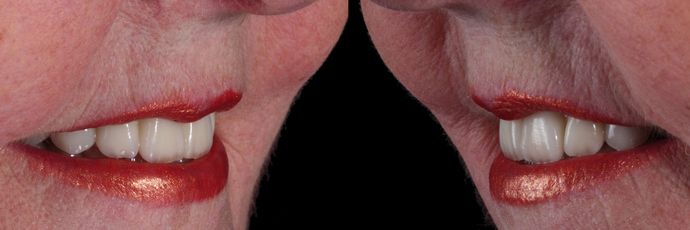 All on 4 Dental Implants: Case  14 - After