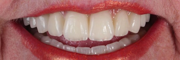 All on 4 Dental Implants: Case  14 - After