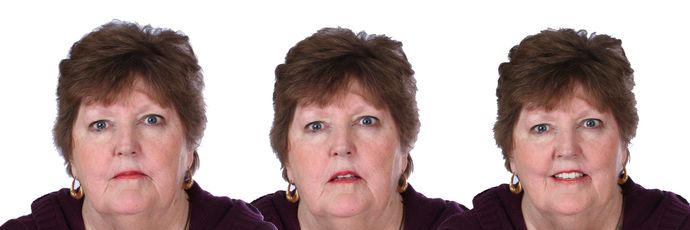 All on 4 Dental Implants: Case  14 - After