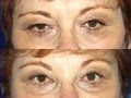 Browlift
