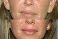 Dermal Injectables