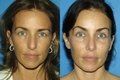 Browlift