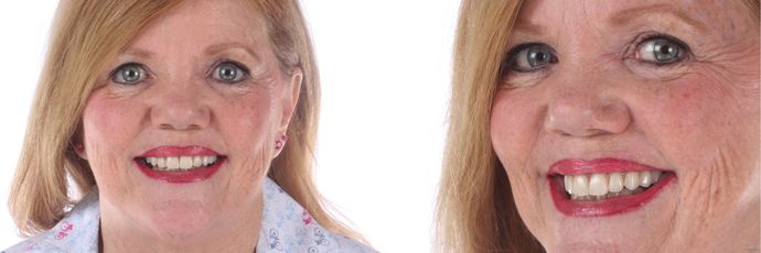 Zirconia Dental Implant Bridge Cases