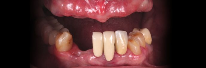 Zirconia Dental Implant Bridge: Case 2 - Before