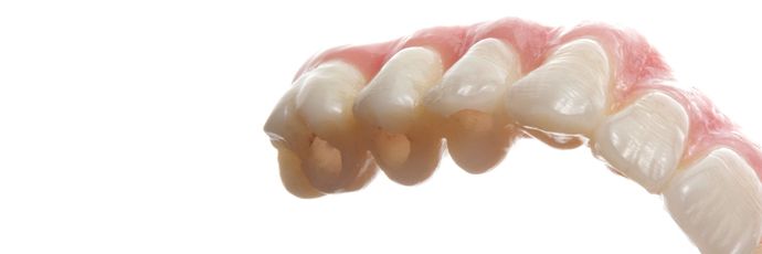 Zirconia Dental Implant Bridge: Case 2 - Lab Work