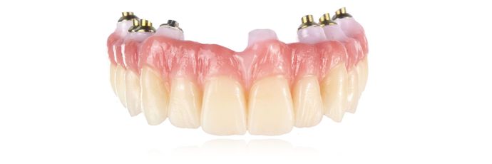 Zirconia Dental Implant Bridge: Case 2 - Lab Work