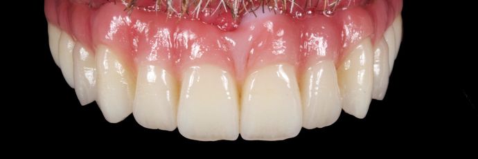 Zirconia Dental Implant Bridge: Case 2 - Try In