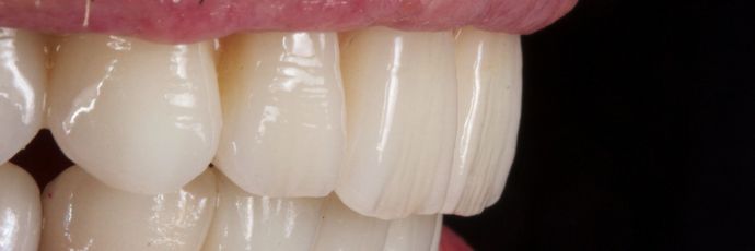 Zirconia Dental Implant Bridge: Case 2 - Try In