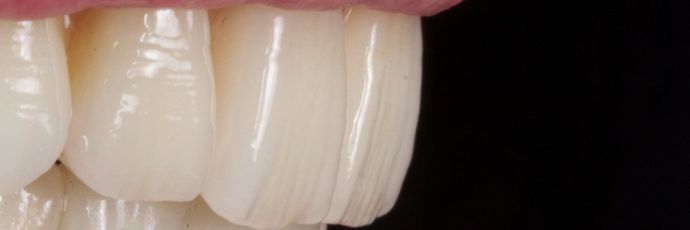Zirconia Dental Implant Bridge: Case 2 - Try In