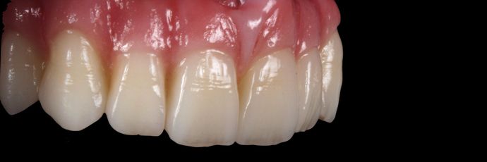 Zirconia Dental Implant Bridge: Case 2 - After