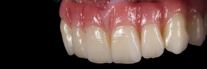 Zirconia Dental Implant Bridge: Case 2 - After