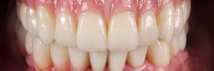 Zirconia Dental Implant Bridge: Case 2 - After