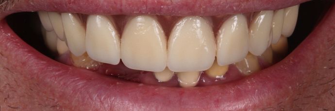 Zirconia Dental Implant Bridge: Case 2 - Before