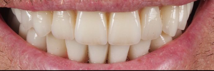 Zirconia Dental Implant Bridge: Case 2 - After