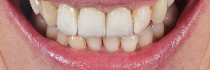 Zirconia Crowns: Case 1 - After