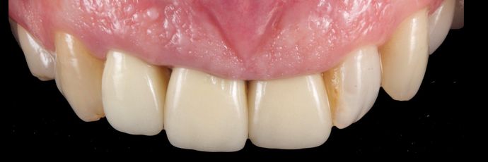 Zirconia Crowns: Case 1 - Before