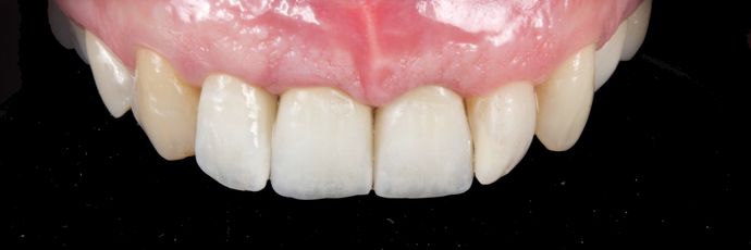 Zirconia Crowns: Case 1 - After