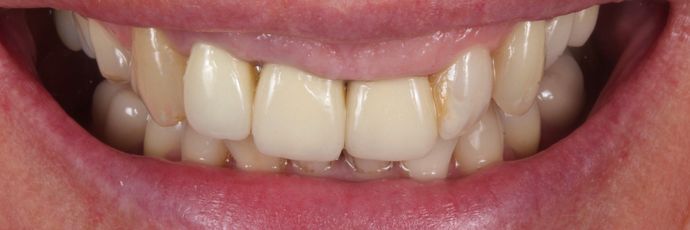 Zirconia Crowns: Case 1 - Before