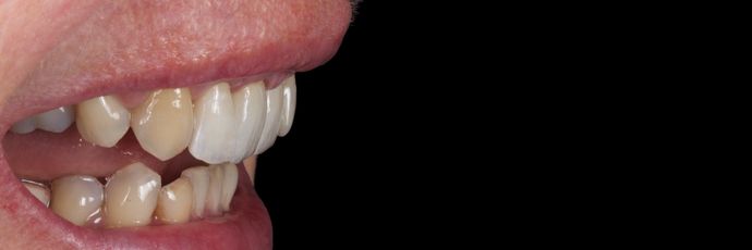 Zirconia Crowns: Case 1 - After