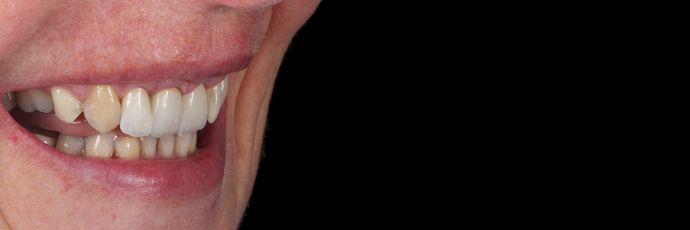 Zirconia Crowns: Case 1 - After
