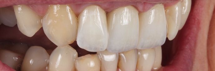 Zirconia Crowns: Case 1 - After