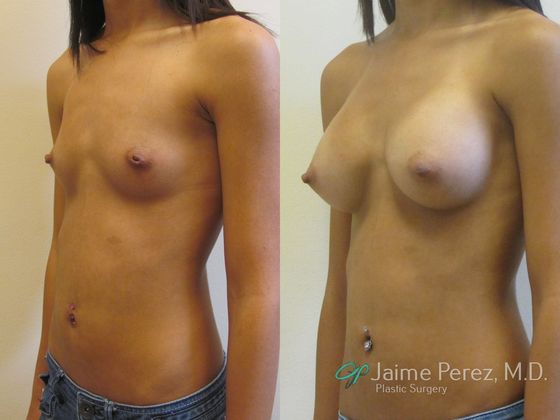 Breast Augmentation: Saline Augmentation, Underarm Scar
