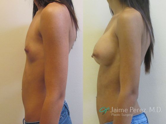 Breast Augmentation: Saline Augmentation, Underarm Scar