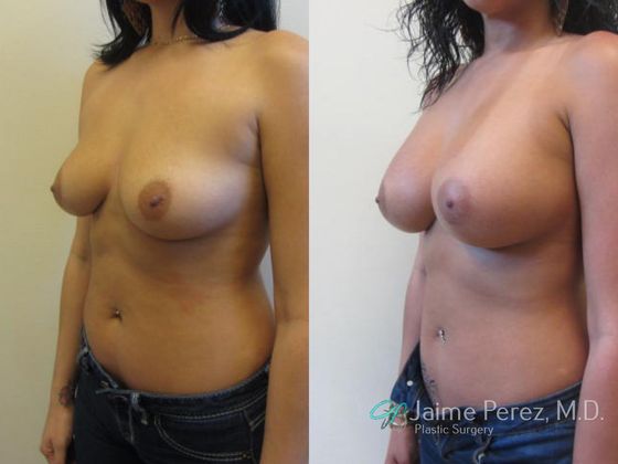 Breast Augmentation: Tampa 450cc Saline Breast Augmentation