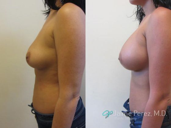 Breast Augmentation: Tampa 450cc Saline Breast Augmentation