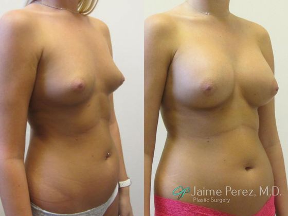 Breast Augmentation: Saline Breast Augmentation