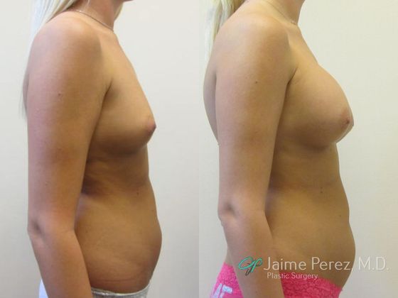 Breast Augmentation: Saline Breast Augmentation