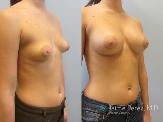 Breast Augmentation: Natrelle 371cc Silicone Aug