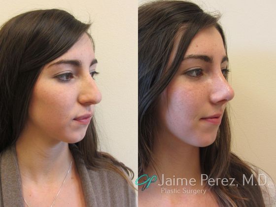 nose job recovery week by week