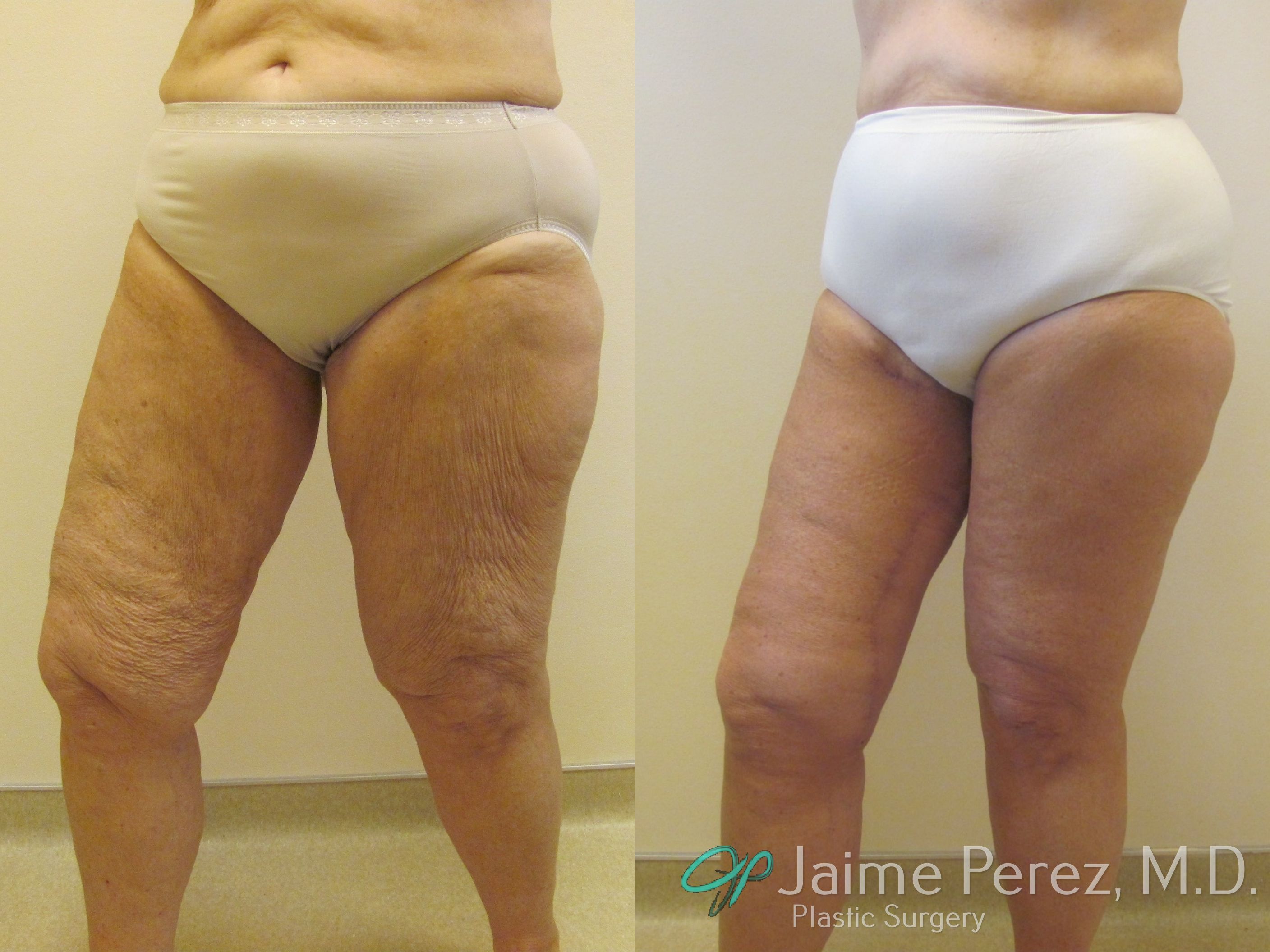 liposuction surgery legs