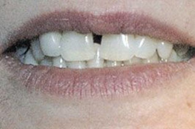Veneers Case 1 - Before