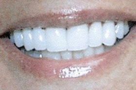 After Porcelain Veneers