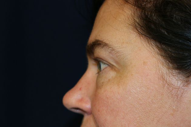 Eye Lift*: Case 6 - Before