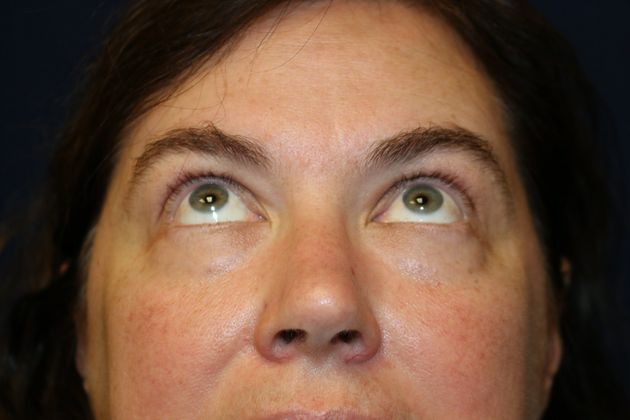 Eye Lift*: Case 6 - Before