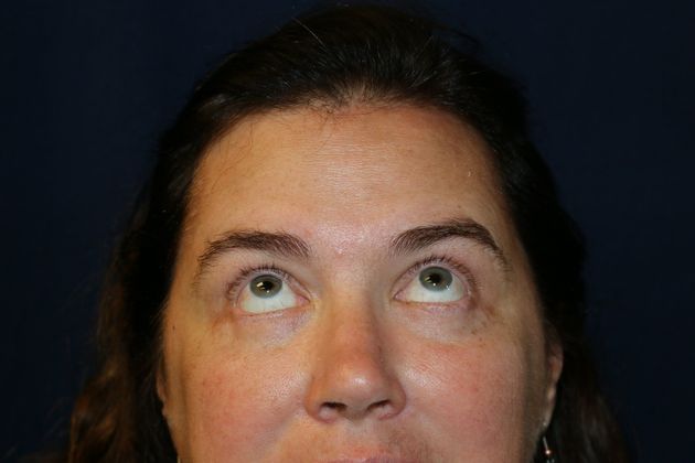 Eye Lift*: Case 6 - After