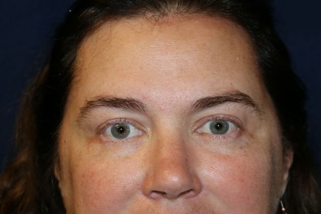 Eye Lift*: Case 6 - After