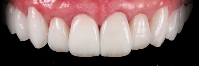 Zirconia Crowns Case 2 - After