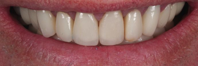 Zirconia Crowns: Case 2 - Before