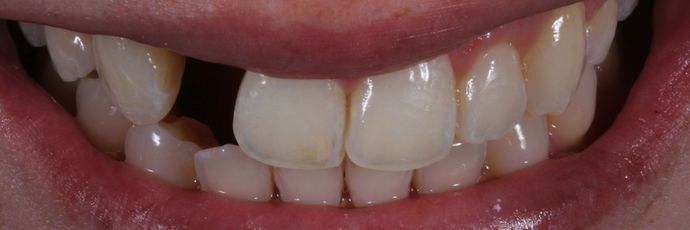 Single Implant Zirconia Crown Case 1 - Before