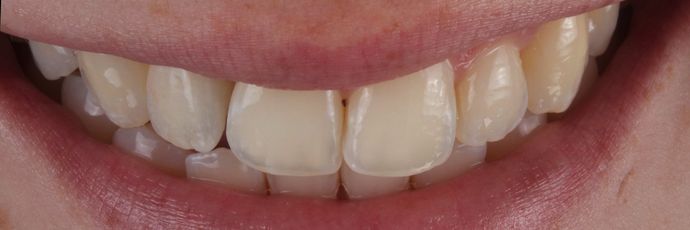 Single Implant Zirconia Crown Case 1 - After